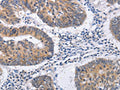 The image on the left is immunohistochemistry of paraffin-embedded Human colon cancer tissue using CSB-PA213853(RCHY1 Antibody) at dilution 1/30, on the right is treated with fusion protein. (Original magnification: ×200)