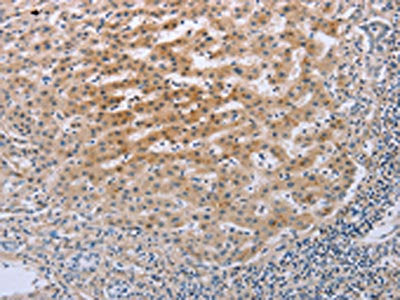 The image on the left is immunohistochemistry of paraffin-embedded Human liver cancer tissue using CSB-PA213899(TNFRSF25  Antibody) at dilution 1/20, on the right is treated with fusion protein. (Original magnification: ×200)
