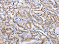 The image on the left is immunohistochemistry of paraffin-embedded Human thyroid cancer tissue using CSB-PA213924(PAX8 Antibody) at dilution 1/25, on the right is treated with fusion protein. (Original magnification: ×200)
