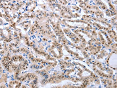 The image on the left is immunohistochemistry of paraffin-embedded Human thyroid cancer tissue using CSB-PA213924(PAX8 Antibody) at dilution 1/25, on the right is treated with fusion protein. (Original magnification: ×200)