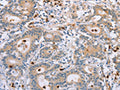 The image on the left is immunohistochemistry of paraffin-embedded Human colon cancer tissue using CSB-PA214768(KLK4 Antibody) at dilution 1/40, on the right is treated with fusion protein. (Original magnification: ×200)
