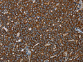The image on the left is immunohistochemistry of paraffin-embedded Human ovarian cancer tissue using CSB-PA215070(GCKR Antibody) at dilution 1/40, on the right is treated with fusion protein. (Original magnification: ×200)