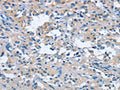 The image on the left is immunohistochemistry of paraffin-embedded Human thyroid cancer tissue using CSB-PA215086(FGF9 Antibody) at dilution 1/25, on the right is treated with fusion protein. (Original magnification: ×200)