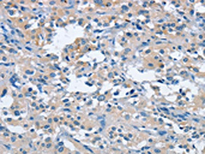 The image on the left is immunohistochemistry of paraffin-embedded Human thyroid cancer tissue using CSB-PA215086(FGF9 Antibody) at dilution 1/25, on the right is treated with fusion protein. (Original magnification: ×200)