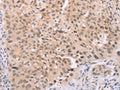 The image on the left is immunohistochemistry of paraffin-embedded Human lung cancer tissue using CSB-PA215248(ADAM11 Antibody) at dilution 1/25, on the right is treated with synthetic peptide. (Original magnification: ×200)