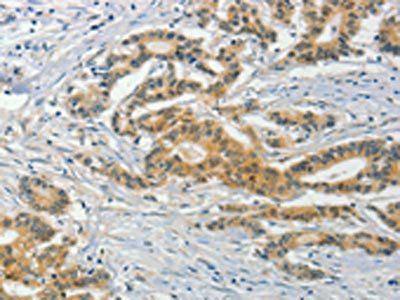 The image on the left is immunohistochemistry of paraffin-embedded Human colon cancer tissue using CSB-PA215341(ASB8 Antibody) at dilution 1/50, on the right is treated with fusion protein. (Original magnification: ×200)