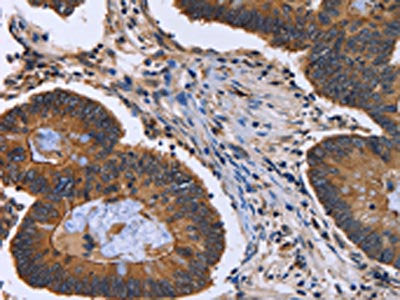 The image is immunohistochemistry of paraffin-embedded Human colon cancer tissue using CSB-PA215571(FRK Antibody) at dilution 1/40. (Original magnification: ×200)