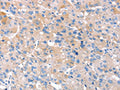 The image on the left is immunohistochemistry of paraffin-embedded Human liver cancer tissue using CSB-PA215699(RNF214 Antibody) at dilution 1/20, on the right is treated with fusion protein. (Original magnification: ×200)