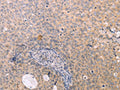 The image on the left is immunohistochemistry of paraffin-embedded Human cervical cancer tissue using CSB-PA215740(NAMPT Antibody) at dilution 1/15, on the right is treated with fusion protein. (Original magnification: ×200)