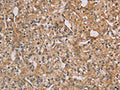 The image on the left is immunohistochemistry of paraffin-embedded Human prostate cancer tissue using CSB-PA215866(CHRNA4 Antibody) at dilution 1/20, on the right is treated with fusion protein. (Original magnification: ×200)