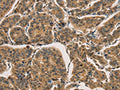 The image on the left is immunohistochemistry of paraffin-embedded Human breast cancer tissue using CSB-PA216273(CTNNBIP1 Antibody) at dilution 1/30, on the right is treated with fusion protein. (Original magnification: ×200)