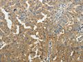 The image on the left is immunohistochemistry of paraffin-embedded Human ovarian cancer tissue using CSB-PA216465(SYT6 Antibody) at dilution 1/40, on the right is treated with fusion protein. (Original magnification: ×200)