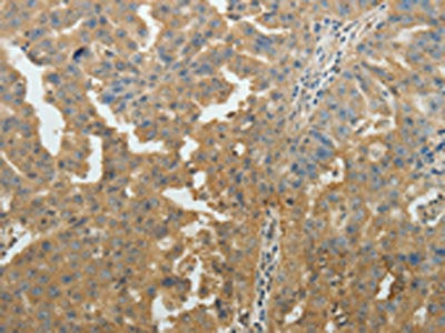 The image on the left is immunohistochemistry of paraffin-embedded Human ovarian cancer tissue using CSB-PA216465(SYT6 Antibody) at dilution 1/40, on the right is treated with fusion protein. (Original magnification: ×200)