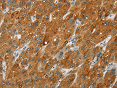 The image on the left is immunohistochemistry of paraffin-embedded Human liver cancer tissue using CSB-PA216877(CYP2E1 Antibody) at dilution 1/30, on the right is treated with fusion protein. (Original magnification: ×200)