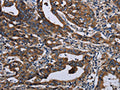 The image on the left is immunohistochemistry of paraffin-embedded Human gastic cancer tissue using CSB-PA217118(LZTFL1 Antibody) at dilution 1/50, on the right is treated with fusion protein. (Original magnification: ×200)