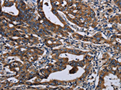The image on the left is immunohistochemistry of paraffin-embedded Human gastic cancer tissue using CSB-PA217118(LZTFL1 Antibody) at dilution 1/50, on the right is treated with fusion protein. (Original magnification: ×200)