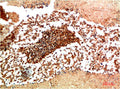 Immunohistochemical analysis of paraffin-embedded Human Lung Carcinoma Tissue using JAK1 Rabbit pAb diluted at 1:200