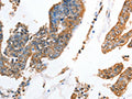 The image on the left is immunohistochemistry of paraffin-embedded Human colon cancer tissue using CSB-PA217516(AKR1D1 Antibody) at dilution 1/35, on the right is treated with fusion protein. (Original magnification: ×200)