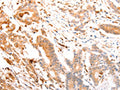 The image on the left is immunohistochemistry of paraffin-embedded Human colon cancer tissue using CSB-PA217707(ABCA4 Antibody) at dilution 1/30, on the right is treated with synthetic peptide. (Original magnification: ×200)