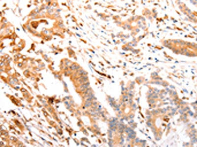 The image on the left is immunohistochemistry of paraffin-embedded Human colon cancer tissue using CSB-PA217707(ABCA4 Antibody) at dilution 1/30, on the right is treated with synthetic peptide. (Original magnification: ×200)
