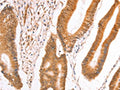 The image on the left is immunohistochemistry of paraffin-embedded Human colon cancer tissue using CSB-PA217735(TAX1BP1 Antibody) at dilution 1/40, on the right is treated with fusion protein. (Original magnification: ×200)
