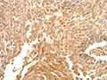 The image on the left is immunohistochemistry of paraffin-embedded Human cervical cancer tissue using CSB-PA217807(SYT6 Antibody) at dilution 1/30, on the right is treated with fusion protein. (Original magnification: ×200)