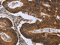 The image on the left is immunohistochemistry of paraffin-embedded Human colon cancer tissue using CSB-PA217817(FGFR1OP Antibody) at dilution 1/50, on the right is treated with fusion protein. (Original magnification: ×200)