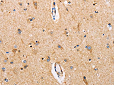 The image on the left is immunohistochemistry of paraffin-embedded Human brain tissue using CSB-PA218040(CTNNA1 Antibody) at dilution 1/15, on the right is treated with fusion protein. (Original magnification: ×200)