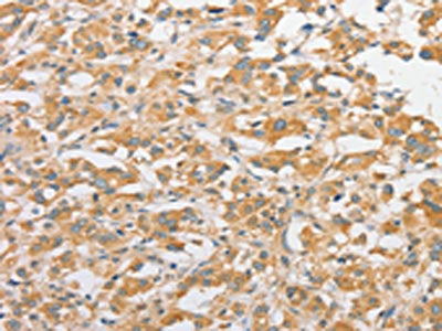 The image on the left is immunohistochemistry of paraffin-embedded Human thyroid cancer tissue using CSB-PA218621(TLR5 Antibody) at dilution 1/30, on the right is treated with fusion protein. (Original magnification: ×200)