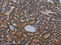 The image on the left is immunohistochemistry of paraffin-embedded Human thyroid cancer tissue using CSB-PA218625(INSIG2 Antibody) at dilution 1/30, on the right is treated with fusion protein. (Original magnification: ×200)
