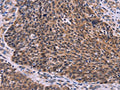 The image on the left is immunohistochemistry of paraffin-embedded Human ovarian cancer tissue using CSB-PA218975(CDC5L Antibody) at dilution 1/30, on the right is treated with fusion protein. (Original magnification: ×200)