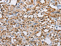 The image on the left is immunohistochemistry of paraffin-embedded Human thyroid cancer tissue using CSB-PA219113(ATXN1 Antibody) at dilution 1/40, on the right is treated with fusion protein. (Original magnification: ×200)