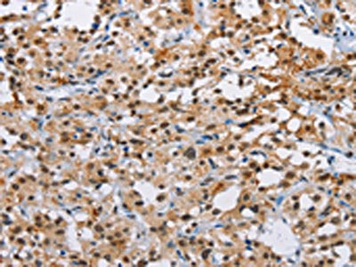 The image on the left is immunohistochemistry of paraffin-embedded Human thyroid cancer tissue using CSB-PA219113(ATXN1 Antibody) at dilution 1/40, on the right is treated with fusion protein. (Original magnification: ×200)