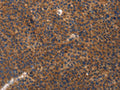 The image on the left is immunohistochemistry of paraffin-embedded Human liver cancer tissue using CSB-PA219130(ITGB3 Antibody) at dilution 1/20, on the right is treated with fusion protein. (Original magnification: ×200)