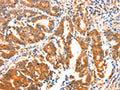 The image on the left is immunohistochemistry of paraffin-embedded Human gastic cancer tissue using CSB-PA219365(AK5 Antibody) at dilution 1/60, on the right is treated with synthetic peptide. (Original magnification: ×200)