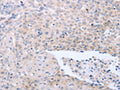 The image on the left is immunohistochemistry of paraffin-embedded Human ovarian cancer tissue using CSB-PA219834(NRTN Antibody) at dilution 1/40, on the right is treated with synthetic peptide. (Original magnification: ×200)