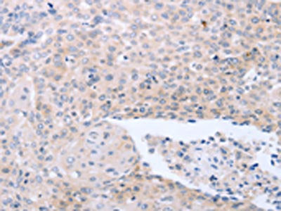 The image on the left is immunohistochemistry of paraffin-embedded Human ovarian cancer tissue using CSB-PA219834(NRTN Antibody) at dilution 1/40, on the right is treated with synthetic peptide. (Original magnification: ×200)