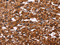 The image on the left is immunohistochemistry of paraffin-embedded Human thyroid cancer tissue using CSB-PA219850(ART5 Antibody) at dilution 1/50, on the right is treated with fusion protein. (Original magnification: ×200)