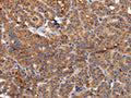 The image on the left is immunohistochemistry of paraffin-embedded Human thyroid cancer tissue using CSB-PA220820(NDUFA1 Antibody) at dilution 1/70, on the right is treated with fusion protein. (Original magnification: ×200)