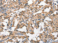 The image on the left is immunohistochemistry of paraffin-embedded Human thyroid cancer tissue using CSB-PA221214(HGF Antibody) at dilution 1/65, on the right is treated with fusion protein. (Original magnification: ×200)