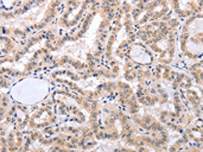 The image on the left is immunohistochemistry of paraffin-embedded Human thyroid cancer tissue using CSB-PA221364(FADD Antibody) at dilution 1/50, on the right is treated with fusion protein. (Original magnification: ×200)