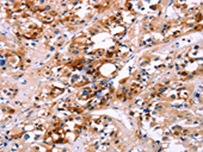 The image on the left is immunohistochemistry of paraffin-embedded Human thyroid cancer tissue using CSB-PA221830(CALB1 Antibody) at dilution 1/60, on the right is treated with fusion protein. (Original magnification: ×200)
