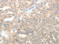 The image on the left is immunohistochemistry of paraffin-embedded Human ovarian cancer tissue using CSB-PA222144(LRP12 Antibody) at dilution 1/20, on the right is treated with fusion protein. (Original magnification: ×200)