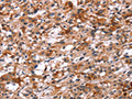 The image on the left is immunohistochemistry of paraffin-embedded Human thyroid cancer tissue using CSB-PA222690(GCGR Antibody) at dilution 1/40, on the right is treated with synthetic peptide. (Original magnification: ×200)