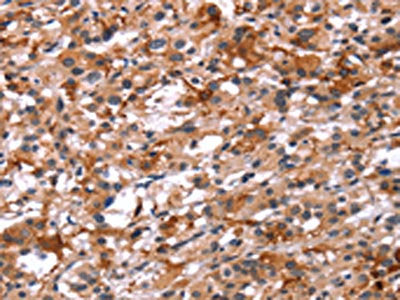 The image on the left is immunohistochemistry of paraffin-embedded Human thyroid cancer tissue using CSB-PA222690(GCGR Antibody) at dilution 1/40, on the right is treated with synthetic peptide. (Original magnification: ×200)