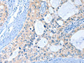 The image on the left is immunohistochemistry of paraffin-embedded Human cervical cancer tissue using CSB-PA223011(ANKRD54 Antibody) at dilution 1/40, on the right is treated with fusion protein. (Original magnification: ×200)