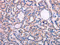 The image on the left is immunohistochemistry of paraffin-embedded Human thyroid cancer tissue using CSB-PA223042(LEP Antibody) at dilution 1/30, on the right is treated with fusion protein. (Original magnification: ×200)