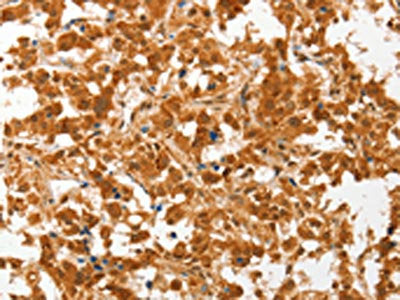 The image on the left is immunohistochemistry of paraffin-embedded Human thyroid cancer tissue using CSB-PA223164(COL4A3BP Antibody) at dilution 1/50, on the right is treated with fusion protein. (Original magnification: ×200)