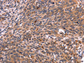 The image on the left is immunohistochemistry of paraffin-embedded Human cervical cancer tissue using CSB-PA223350(CRK Antibody) at dilution 1/40, on the right is treated with fusion protein. (Original magnification: ×200)