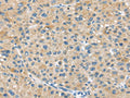 The image on the left is immunohistochemistry of paraffin-embedded Human liver cancer tissue using CSB-PA223592(ABCC2 Antibody) at dilution 1/45, on the right is treated with synthetic peptide. (Original magnification: ×200)